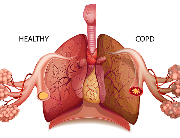 National COPD Awareness Month Explore A Common Lung Disease